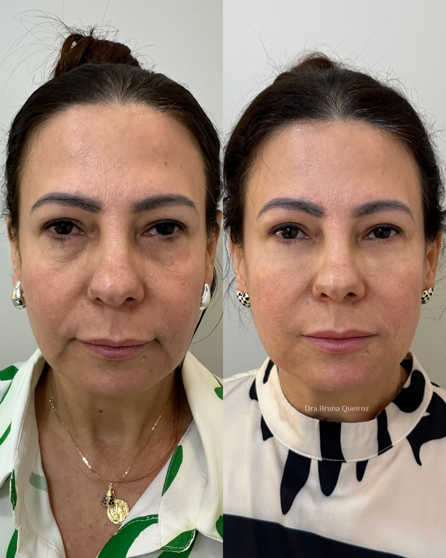Rejuvenescimento facial 