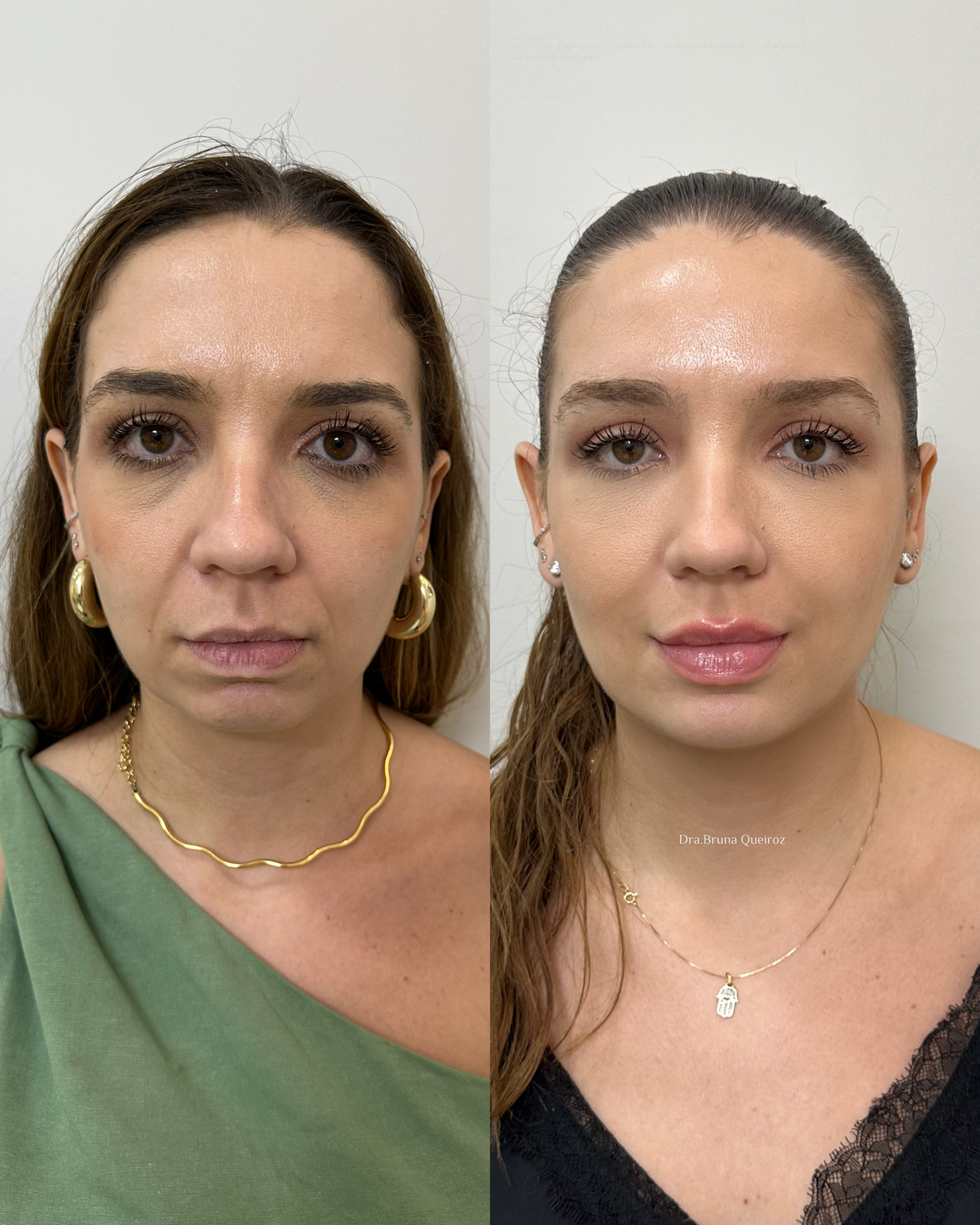 Embelezamento facial 